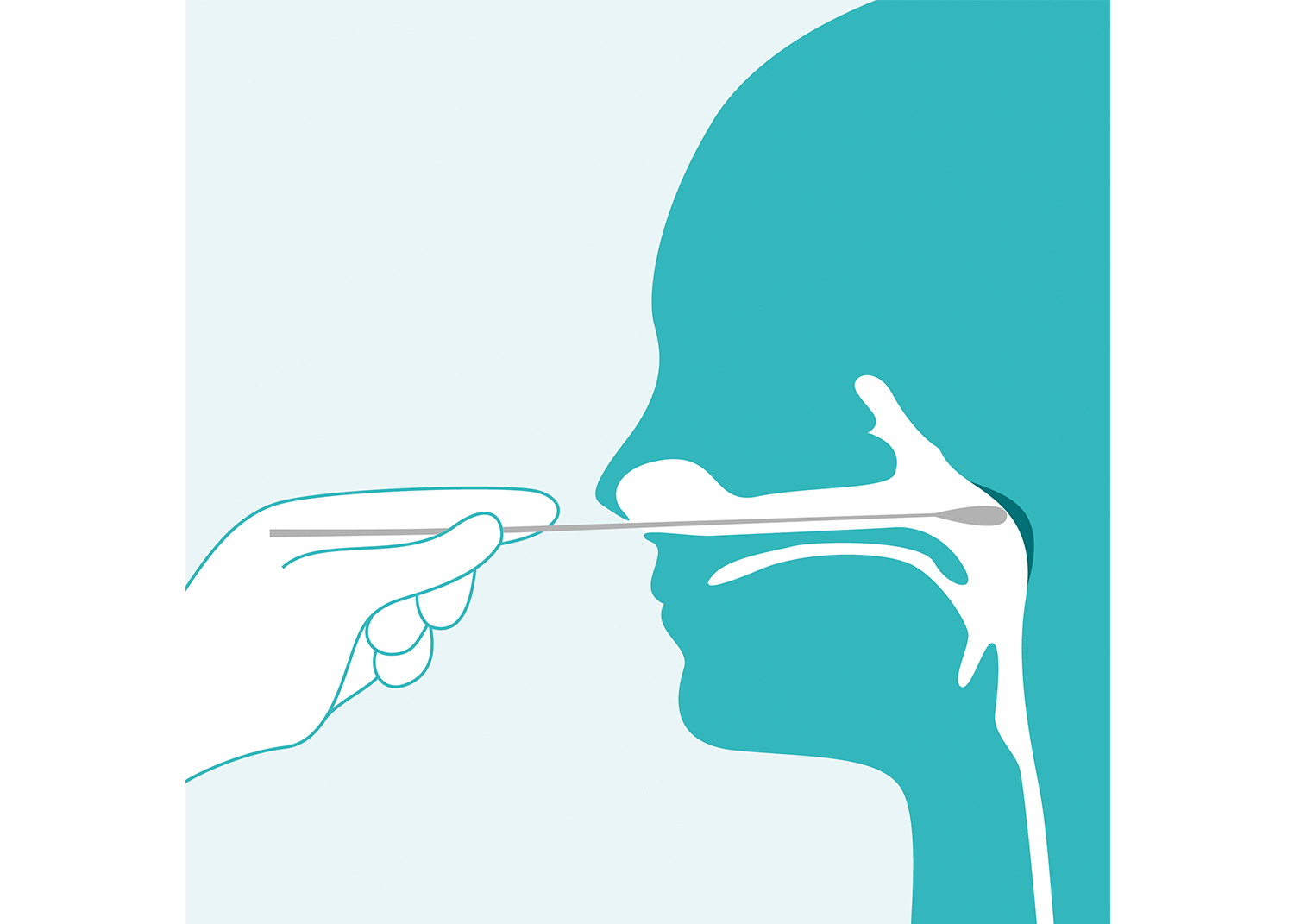 Illustration eines Nasopharyngealabstrichs